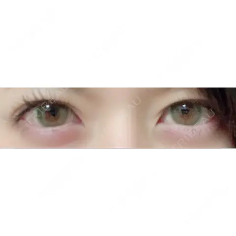 ヒアルロン酸注入（涙袋） フィラークリニック 池袋院 AFTER