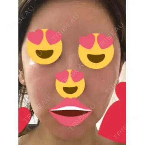 脂肪吸引（顔） / ヒアルロン酸注入（あご） / ボトックス（エラ・小顔） エートップ美容整形外科 AFTER