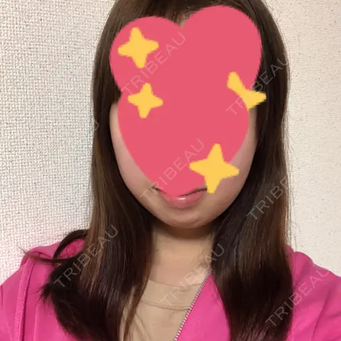 糸リフト / バッカルファット除去 湘南美容クリニック 大阪京橋院 AFTER
