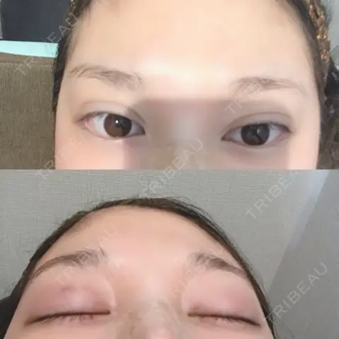 二重埋没 湘南美容クリニック 奈良院 DAY 0