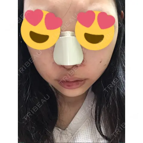 隆鼻術 / 鼻中隔延長（切開） / 骨切幅寄せ / プロテーゼ除去 マーブル美容整形外科 DAY 3