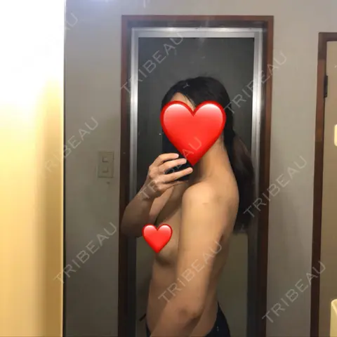 脂肪吸引（二の腕） 狎鴎亭トップライン医院 DAY 3