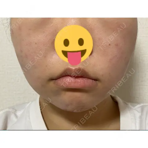 糸リフト / バッカルファット除去 / 脂肪吸引（顔） / ボトックス（エラ・小顔） 藤・ナチュレ美容クリニック 恵比寿院 DAY 0