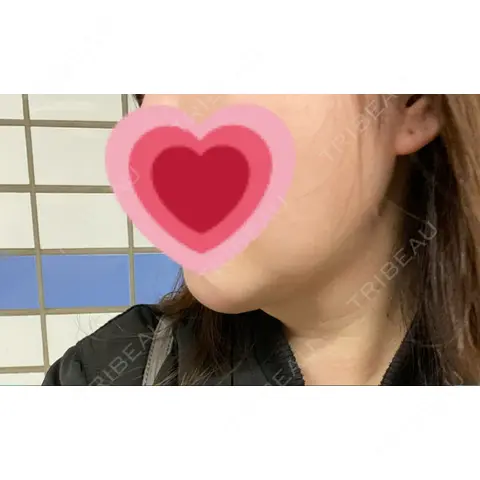 糸リフト / その他（輪郭） YJホーリック美容外科 AFTER