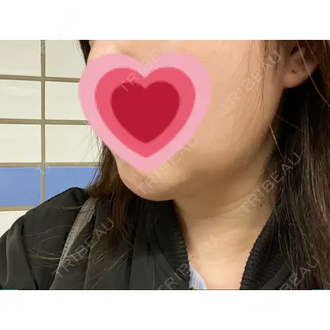糸リフト / その他（輪郭） YJホーリック美容外科 AFTER