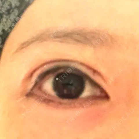 二重切開 リビジョンクリニック（旧：池本形成外科・美容外科） DAY 0