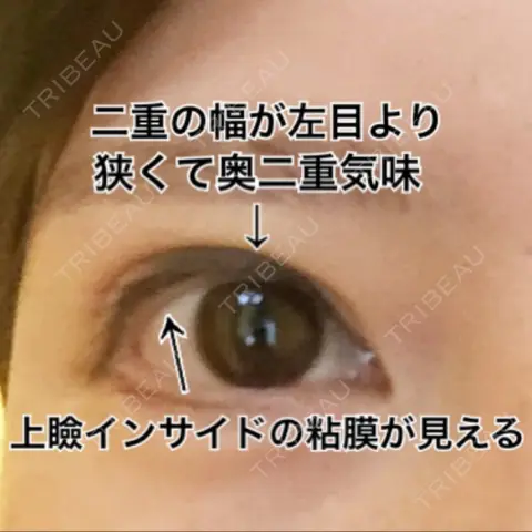 二重切開 リビジョンクリニック（旧：池本形成外科・美容外科） AFTER