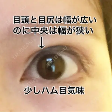 二重切開 リビジョンクリニック（旧：池本形成外科・美容外科） AFTER