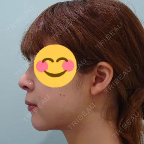 脂肪吸引（顔） / ボトックス（エラ・小顔） WOM CLINIC GINZA （ワム クリニック ギンザ） DAY 1