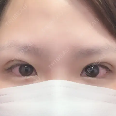 二重埋没 / 上まぶたの脂肪取り 品川美容外科 岡山院 DAY 0