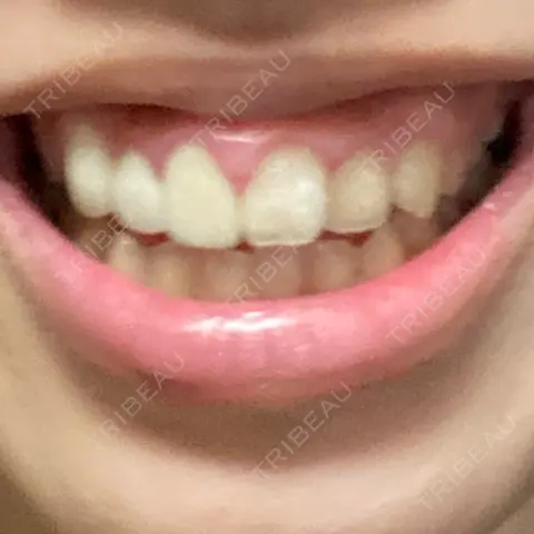 ガミースマイル手術 有楽町美容外科クリニック AFTER