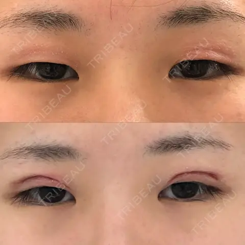 二重埋没 BIANCA銀座 DAY 0