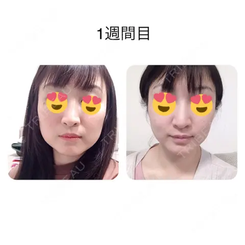 肌ヒアルロン酸注入（たるみ・シワ改善） / ボトックス（エラ・小顔） / 脂肪溶解注射（顔） 湘南美容クリニック 岡山院 AFTER