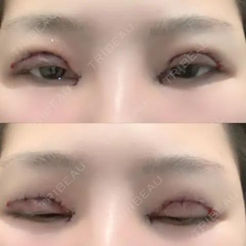 二重切開 / 目頭切開 / 上まぶたたるみ取り 湘南美容クリニック 熊本院 DAY 0