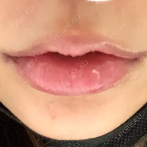 口角挙上 聖心美容クリニック 六本木院 DAY 0