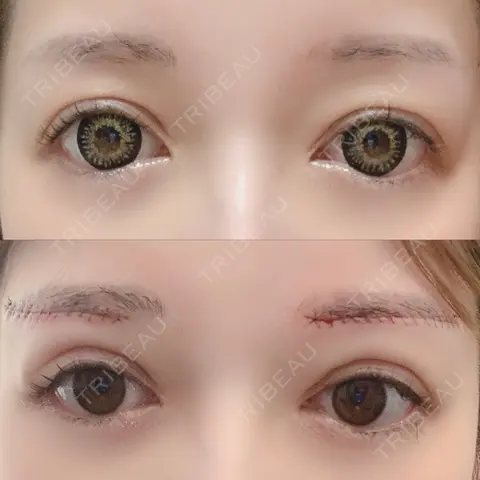眉下切開 福岡TAクリニック DAY 0