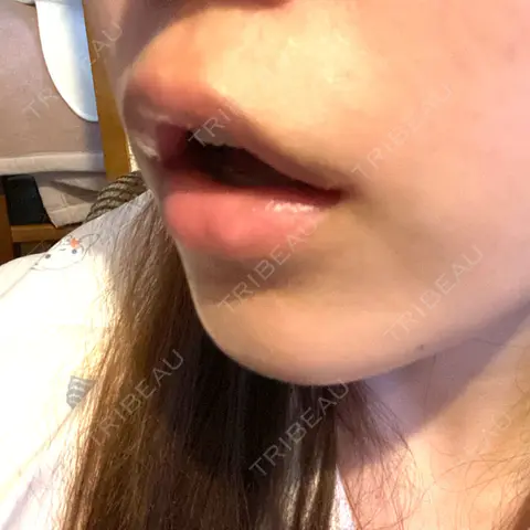口角挙上 聖心美容クリニック 六本木院 AFTER