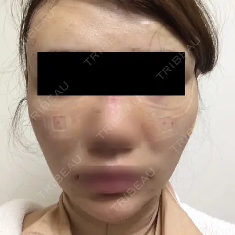 脂肪吸引（顔） / 脂肪注入（輪郭） Clinic Nine Fields DAY 1