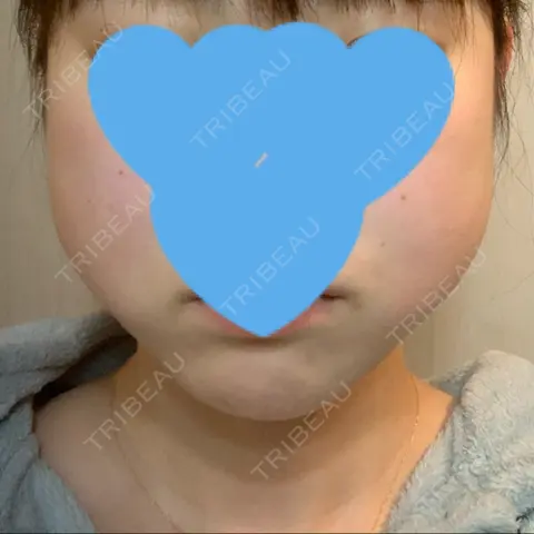 ヒアルロン酸注入（あご） 福岡TAクリニック DAY 0