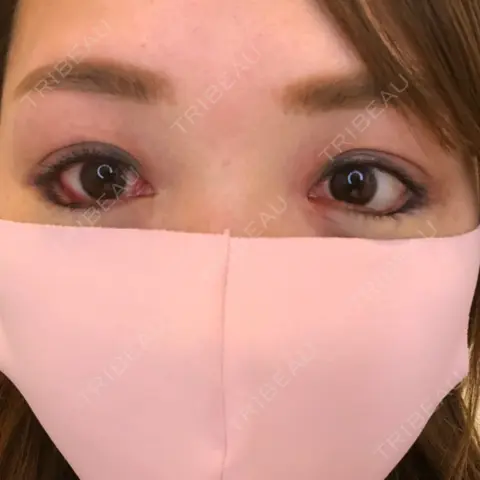 タレ目形成・グラマラスライン（切開） B-LINE CLINIC 池袋院 DAY 0