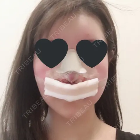 鼻尖形成（切開） / 鼻中隔延長（切開） / 小鼻縮小（切開） / 軟骨移植 / 骨切幅寄せ / 眉間プロテーゼ / プロテーゼ除去 / 鼻修正 / 鼻尖縮小 / その他（鼻） FROM B整形外科 (旧バウム整形外科) DAY 0