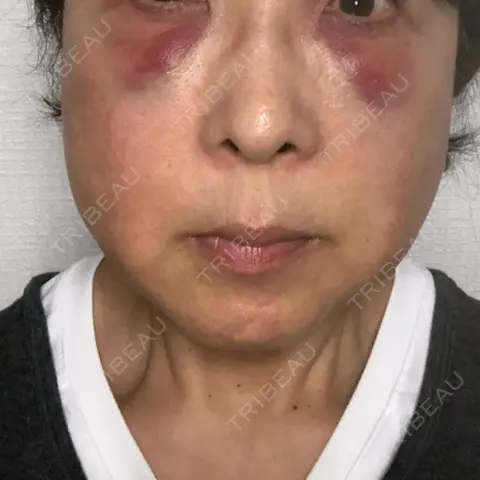 糸リフト / 下まぶたの脂肪取り TCB東京中央美容外科 京都駅前院 DAY 1