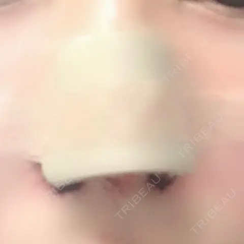 鼻尖形成（切開） / 小鼻縮小（切開） / 鼻孔縁挙上 銀座TAクリニック DAY 0