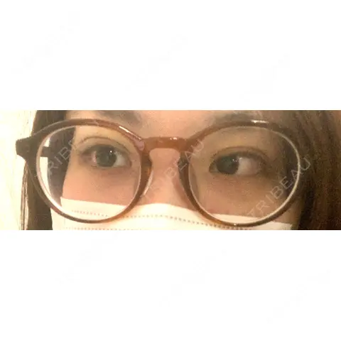 二重埋没 東京イセアクリニック DAY 0