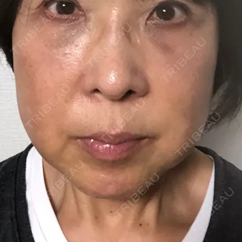 糸リフト / 下まぶたの脂肪取り TCB東京中央美容外科 京都駅前院 AFTER