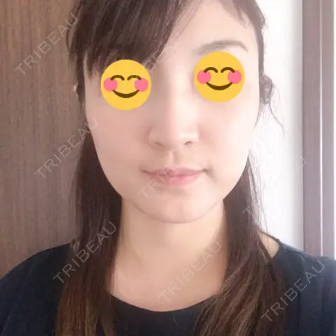 ハイフ（顔） 湘南美容クリニック 岡山院 AFTER