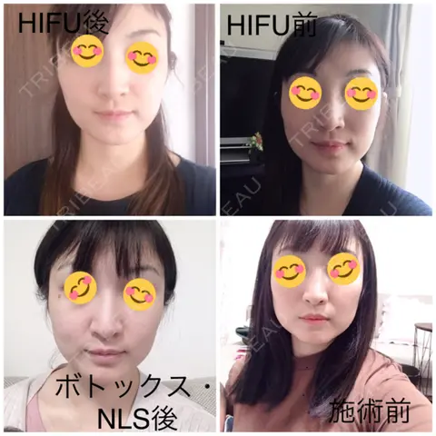 肌ヒアルロン酸注入（たるみ・シワ改善） / ボトックス（エラ・小顔） / 脂肪溶解注射（顔） 湘南美容クリニック 岡山院 AFTER