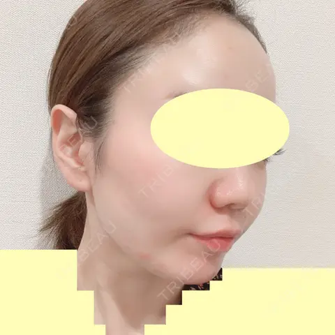 糸リフト / 肌ヒアルロン酸注入（たるみ・シワ改善） TCB東京中央美容外科 中野院 AFTER
