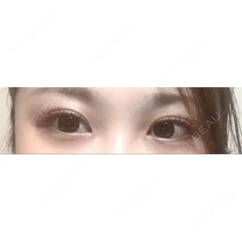 二重埋没 東京イセアクリニック AFTER