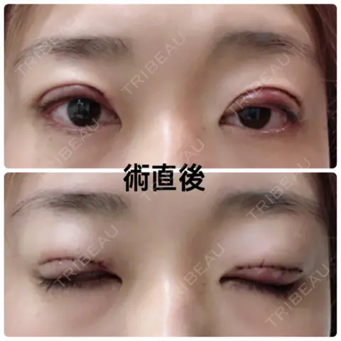 二重切開 水の森美容クリニック 東京銀座院 DAY 0