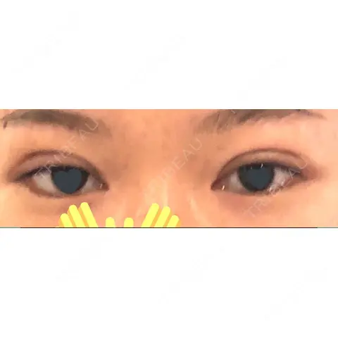 二重埋没 すなおクリニック DAY 0
