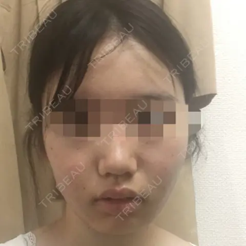 脂肪吸引（顔） アサミ美容外科 大阪院 DAY 0