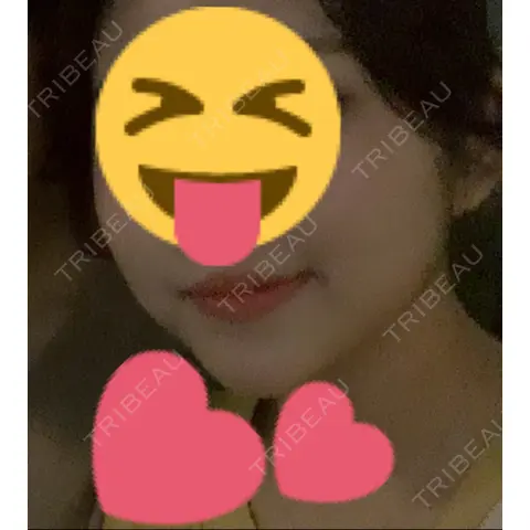 ヒアルロン酸注入（あご） TCB東京中央美容外科 川口院 AFTER