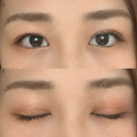 二重埋没 湘南美容クリニック 西宮北口院 AFTER