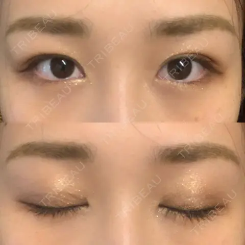 二重埋没 湘南美容クリニック 西宮北口院 AFTER