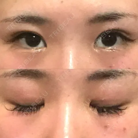 二重埋没 BIANCA銀座 AFTER