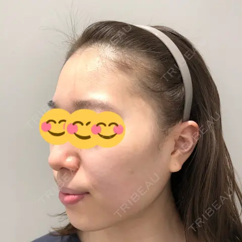 その他（輪郭） Beauty Connection Ginza Clinic（BCGクリニック） AFTER