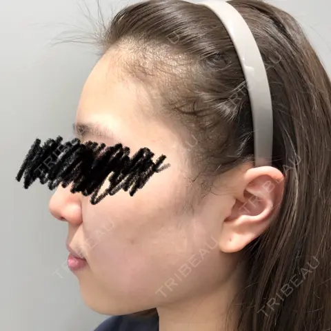 その他（輪郭） Beauty Connection Ginza Clinic（BCGクリニック） AFTER