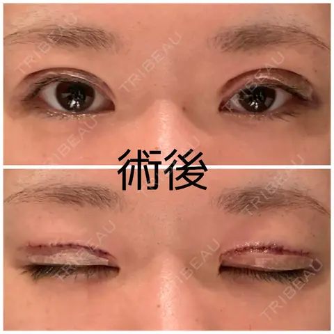 二重切開 / 眼瞼下垂（切開） 飯尾形成外科クリニック DAY 0