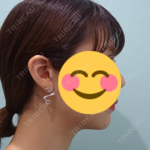 脂肪吸引（顔） / ボトックス（エラ・小顔） WOM CLINIC GINZA （ワム クリニック ギンザ） AFTER