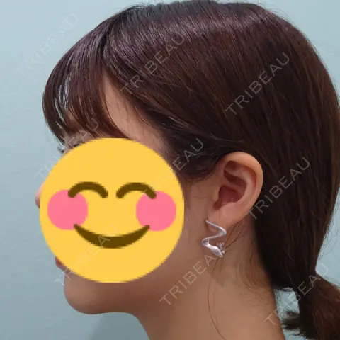 脂肪吸引（顔） / ボトックス（エラ・小顔） WOM CLINIC GINZA （ワム クリニック ギンザ） AFTER