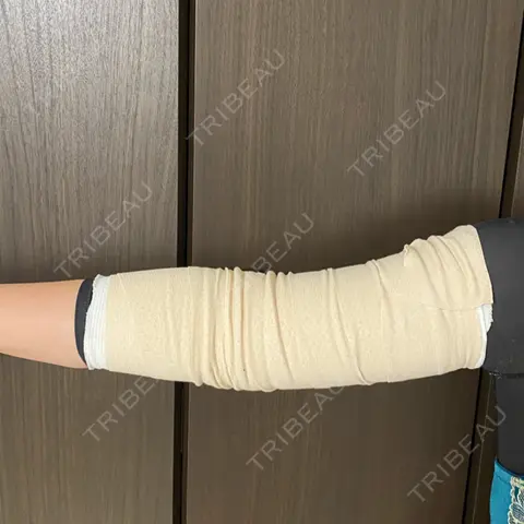 脂肪吸引（二の腕） 湘南美容クリニック 千葉センシティ院 DAY 0