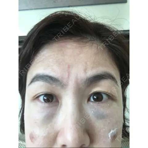 下まぶたの脂肪取り セオリークリニック DAY 0