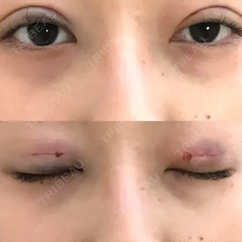 二重埋没 A CLINIC（エークリニック） 銀座院 DAY 0
