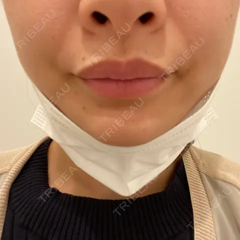 アートメイク（唇） BMC CLINIC 南青山 AFTER