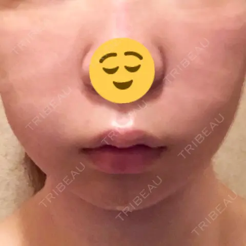 脂肪吸引（顔） / メーラーファット除去 / ボトックス（あご） WOM CLINIC GINZA （ワム クリニック ギンザ） DAY 0